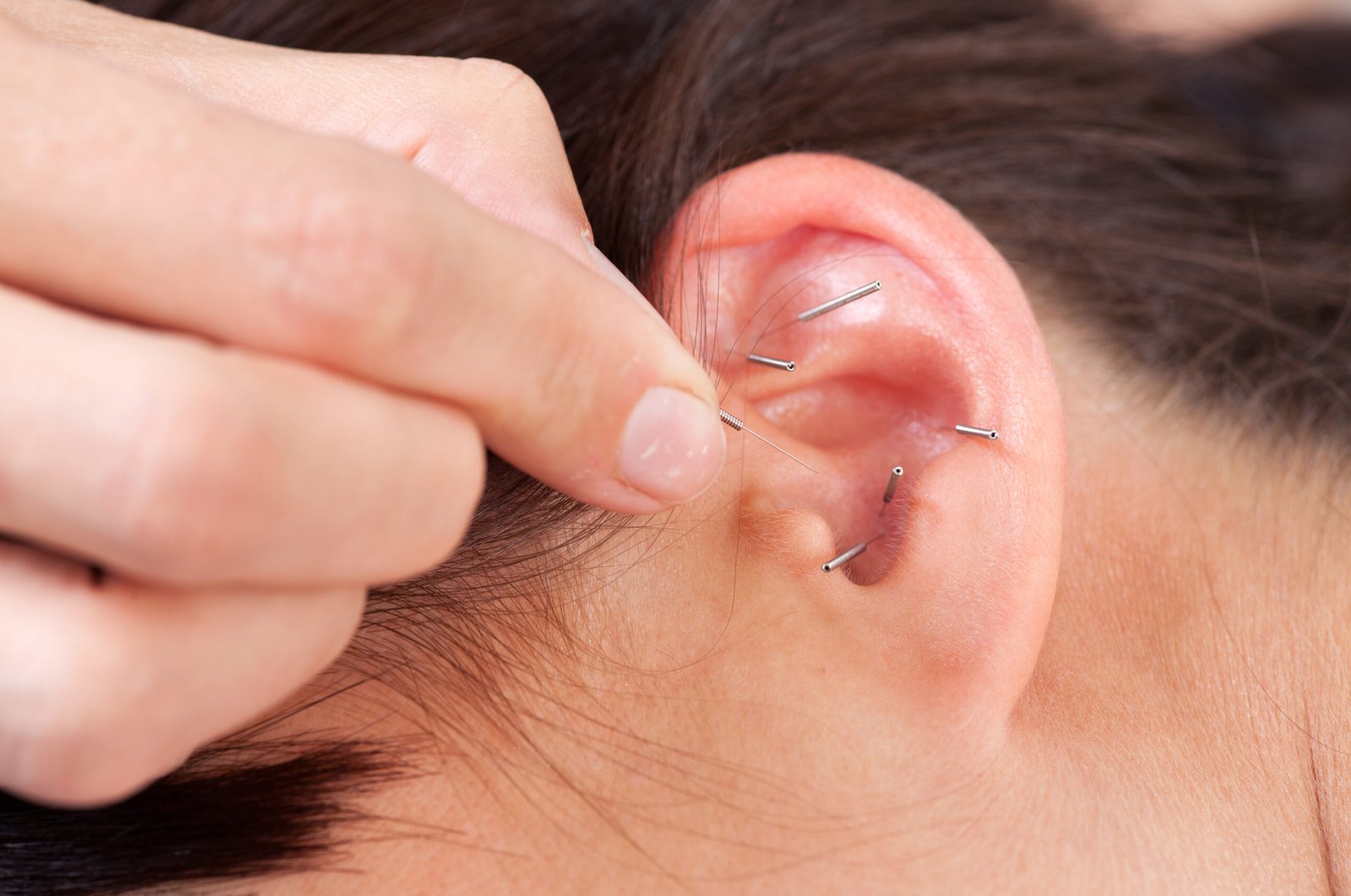 Acupuncture therapist placing needle in ear of patient
