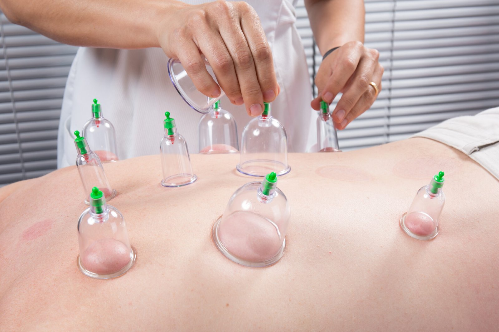 Detail of an acupuncture therapist removing a plastic  globe in a  cupping procedure